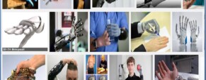 Firenze, al via la sperimentazione della mano bionica